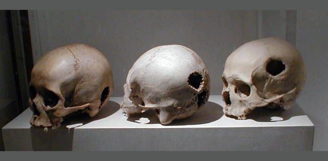 Трепанацию черепа делали тысячи лет назад
